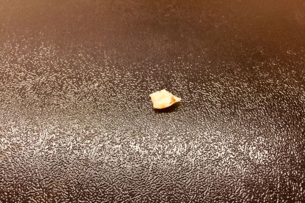 Chipped Tooth