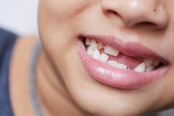 Kid with Chipped Tooth
