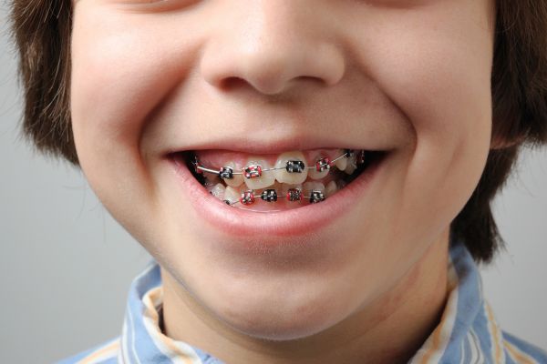 Braces